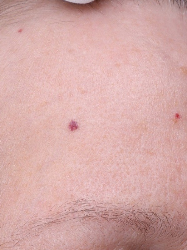 Red marks and redness on the forehead, before, at Arnprior Med Spa