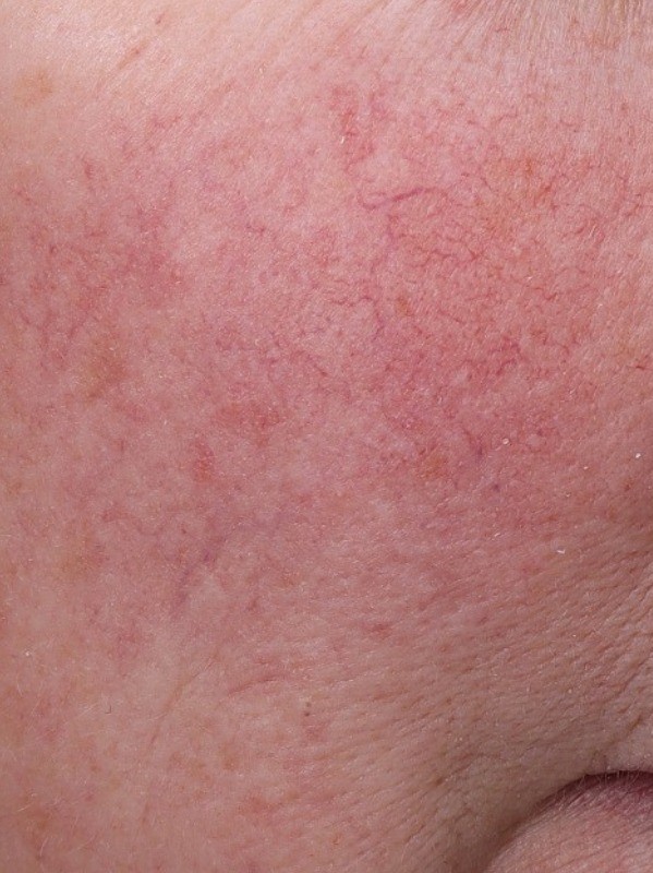 Facial redness and visible capillaries on the cheek, before, at Arnprior Med Spa