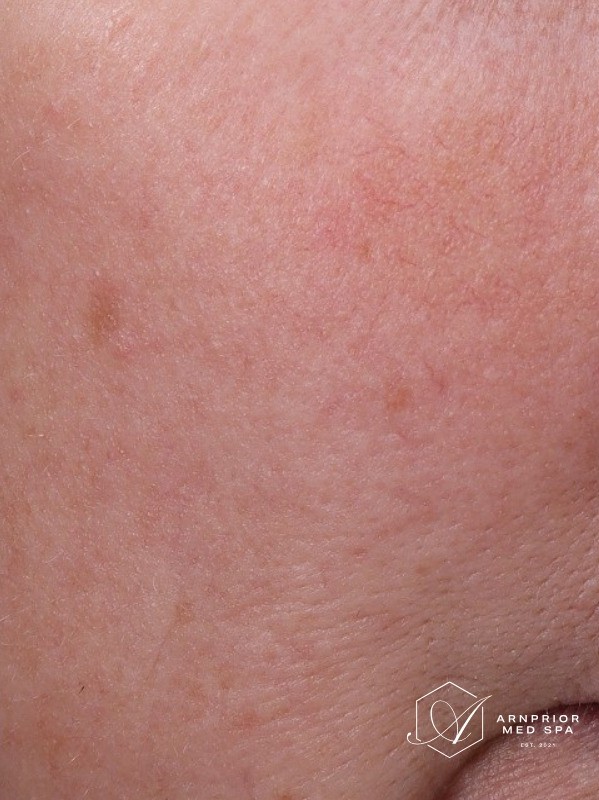 after, softened facial redness on the upper cheek, Arnprior Med Spa