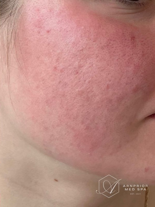 Active acne and scarring on the cheek and jaw, after CO2 laser resurfacing at Arnprior Med Spa