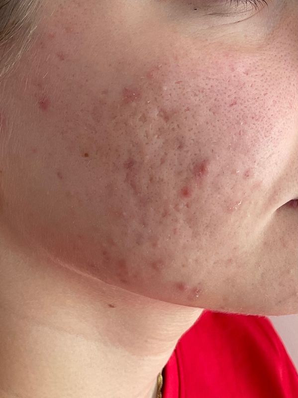 Active acne and scarring on the cheek and jaw, before CO2 laser resurfacing at Arnprior Med Spa
