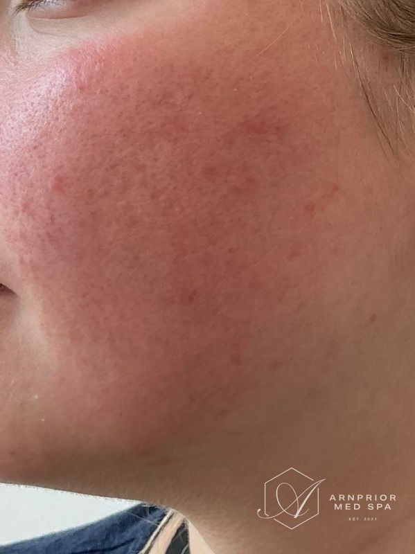 Active acne and scarring along the jaw, after CO2 skin resurfacing at Arnprior Med Spa