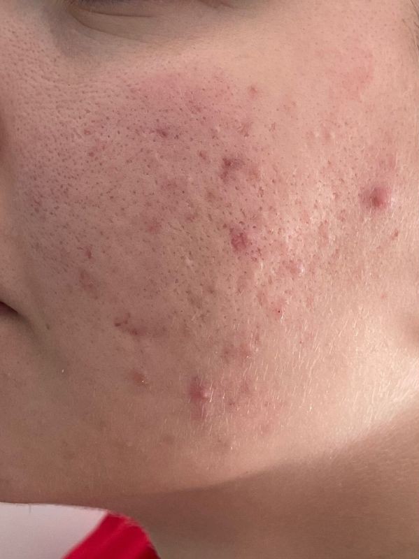 Active acne and scarring along the jaw, before CO2 skin resurfacing at Arnprior Med Spa