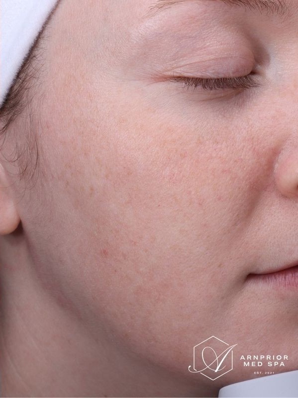 Acne scars after Fractional laser skin resurfacing