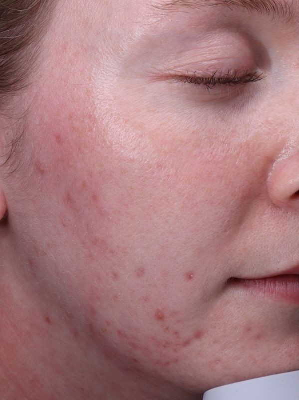 Acne scars before Fractional laser skin resurfacing