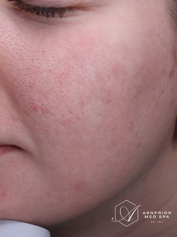 Treatment result at Arnprior Med Spa, after