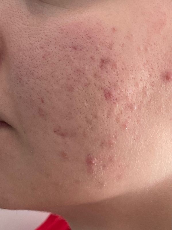 Treatment result at Arnprior Med Spa, before