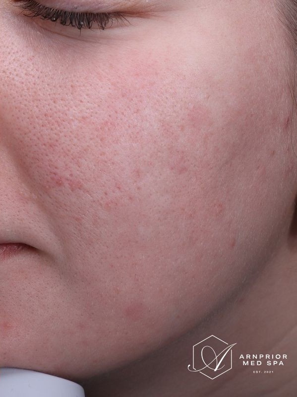 Acne scars after CO2 Laser Resurfacing