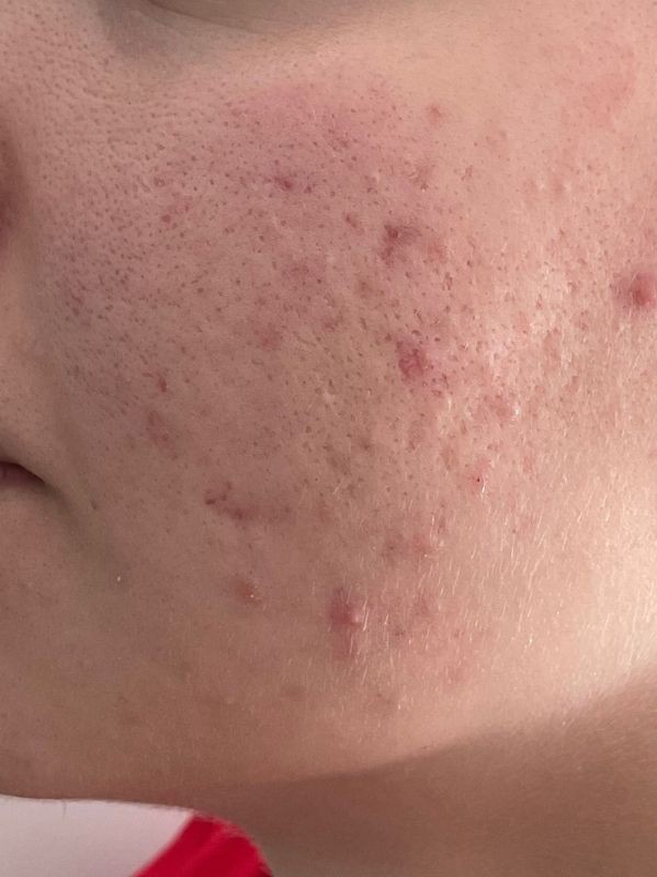 Acne scars before CO2 Laser Resurfacing