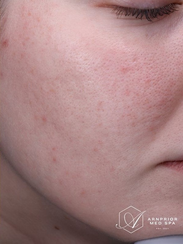 Treatment result at Arnprior Med Spa, after