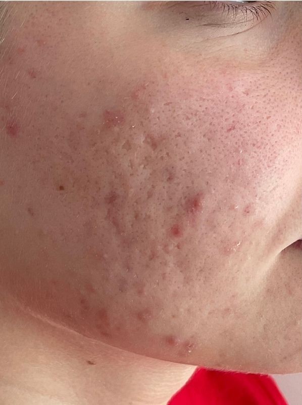 Acne scars before CO₂ laser resurfacing
