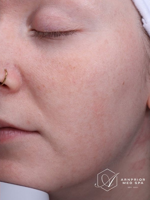 Acne scars after Fractional laser skin resurfacing