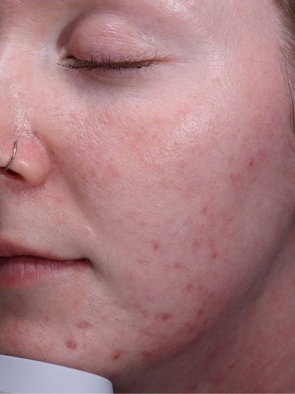 Acne scars before Fractional laser skin resurfacing