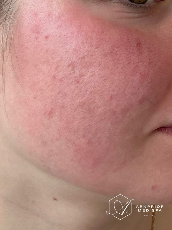 Acne scars after RF Microneedling and CO2 Laser