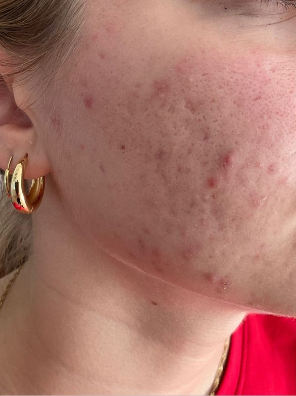 Acne scars before RF Microneedling and CO2 Laser