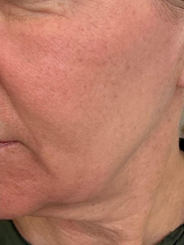 After single session of CO2 Skin Resurfacing for pigmentation and texture, after