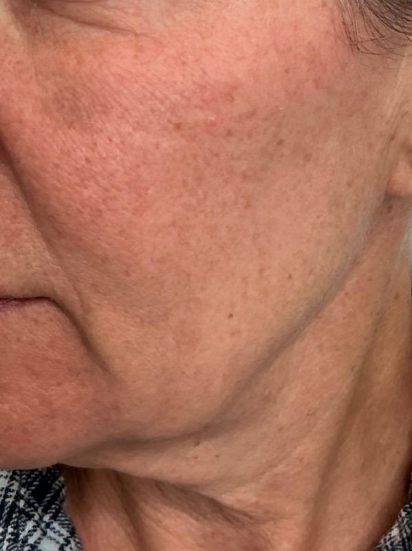 After single session of CO2 Skin Resurfacing for pigmentation and texture, before
