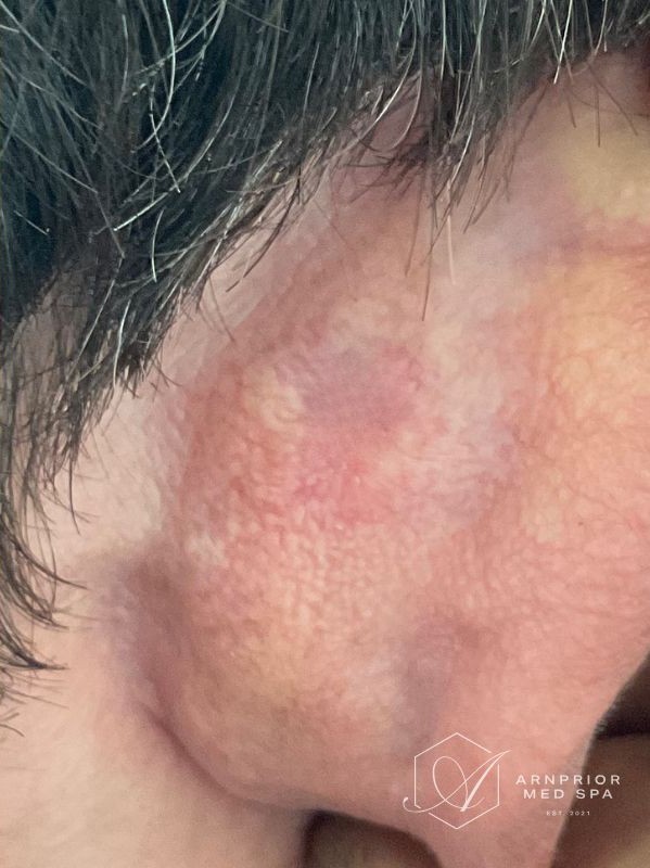 Benign lesion after Plexr plasma removal at Arnprior Med Spa
