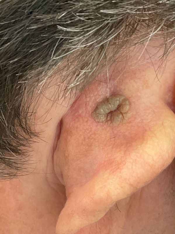 Benign lesion before Plexr plasma removal at Arnprior Med Spa