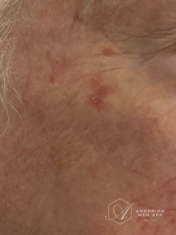 Benign lesion removal with Plexr plasma device, after