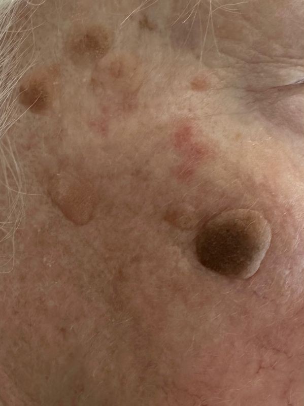 Benign lesion removal with Plexr plasma device, before