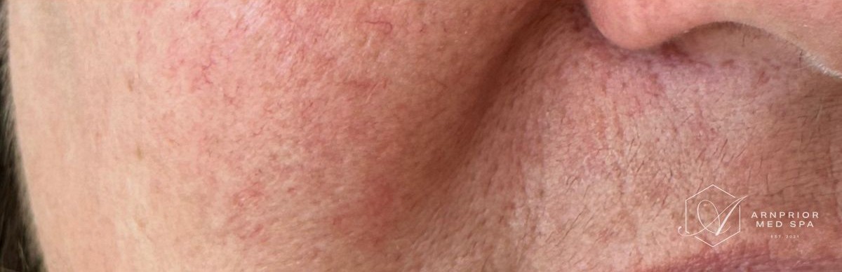 Cheek benign lesion after Removal with Plexr plasma device