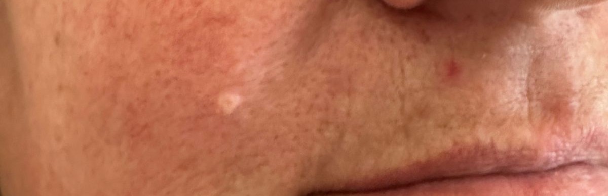 Cheek benign lesion before Removal with Plexr plasma device