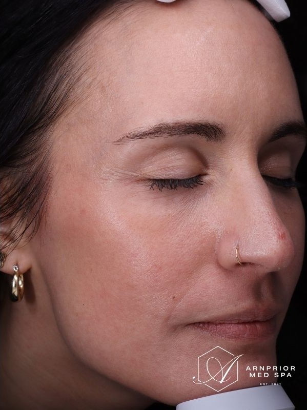 CO2 laser resurfacing after