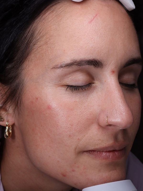 CO2 laser resurfacing before