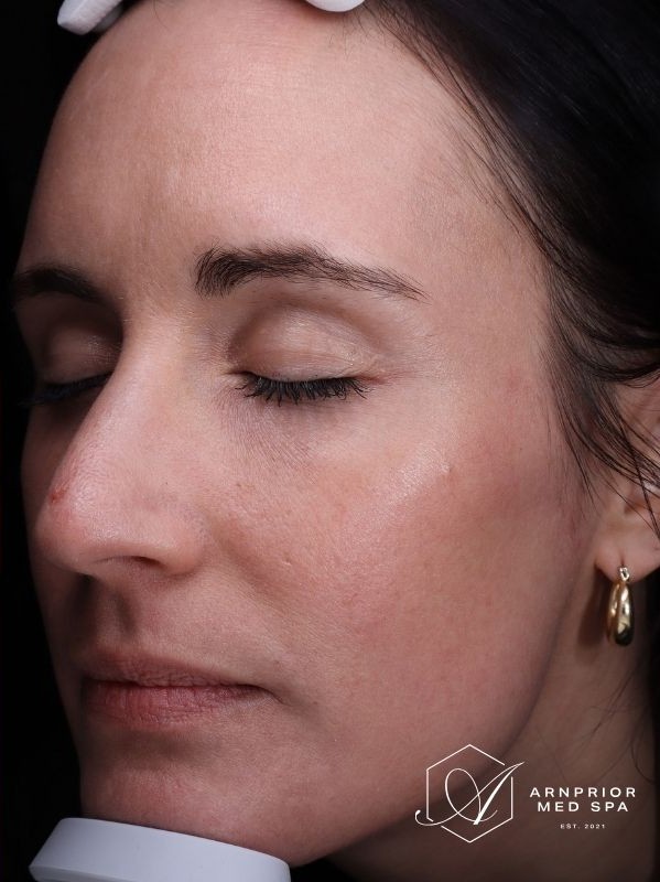 CO2 laser resurfacing after