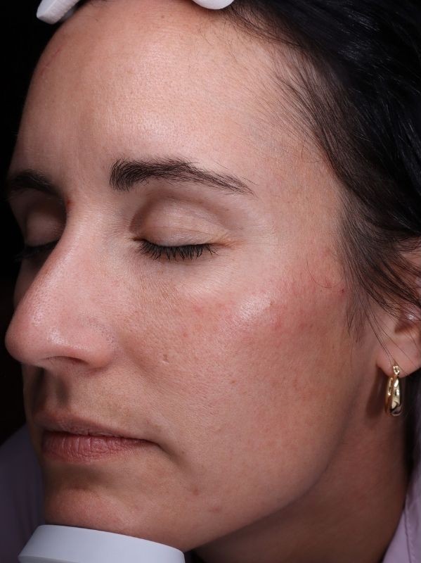 CO2 laser resurfacing before