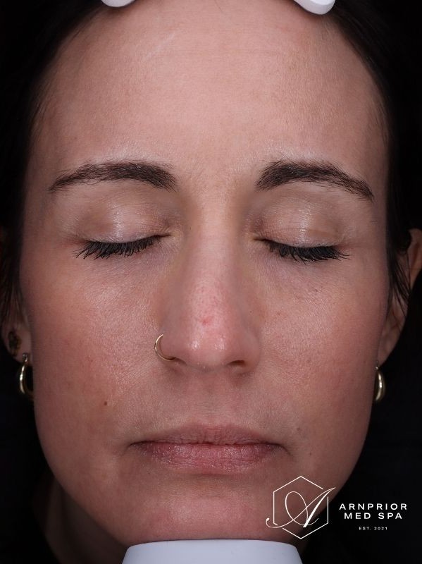 CO2 laser resurfacing after