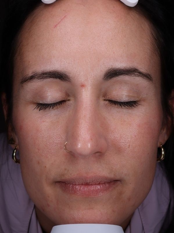 CO2 laser resurfacing before