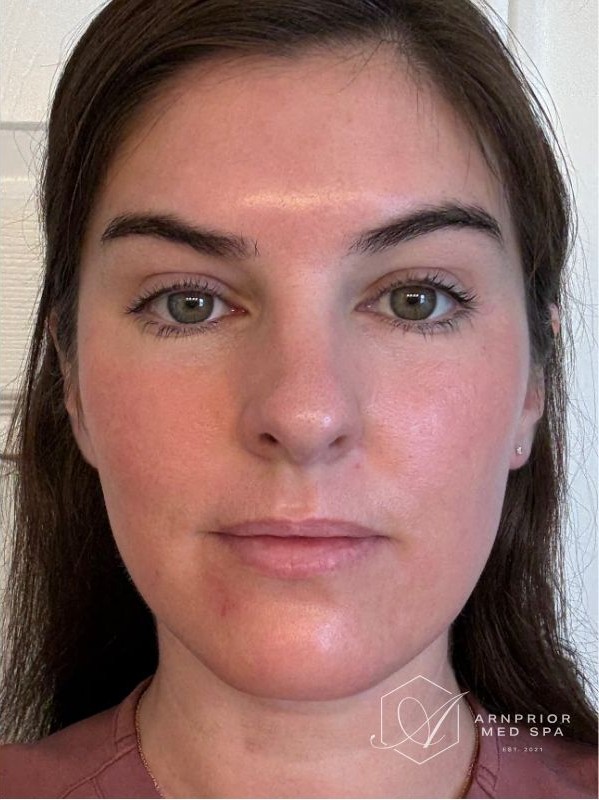 Full face texture and tone after CO2 laser resurfacing at Arnprior Med Spa
