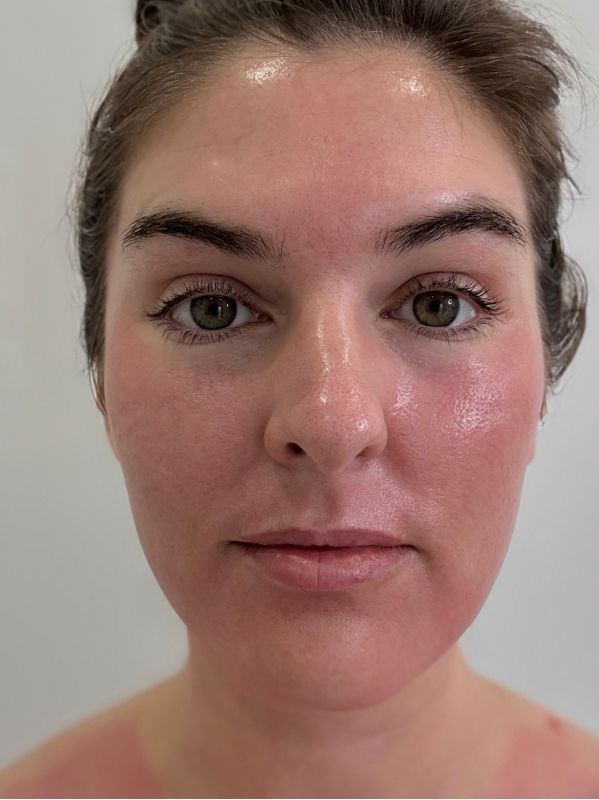 Full face texture and tone before CO2 laser resurfacing at Arnprior Med Spa