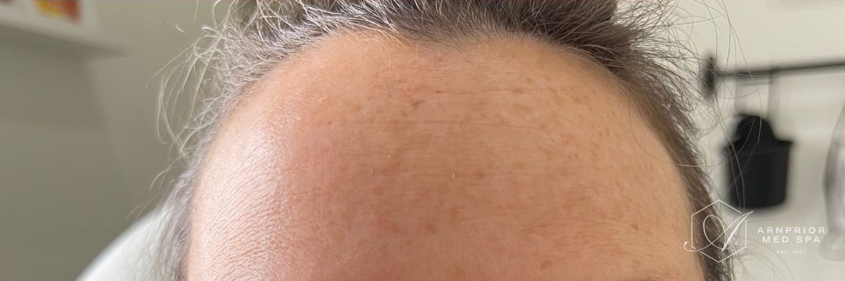 Forehead wrinkles after Dysport in Arnprior ON