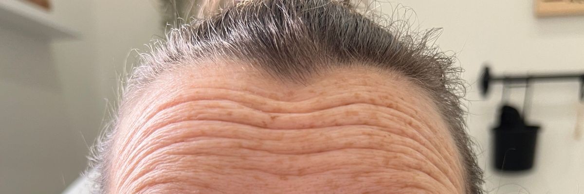 Forehead wrinkles before Dysport in Arnprior ON