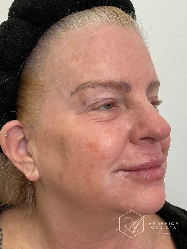 after CO2 Skin Resurfacing
