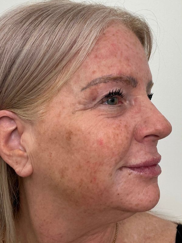 before CO2 Skin Resurfacing