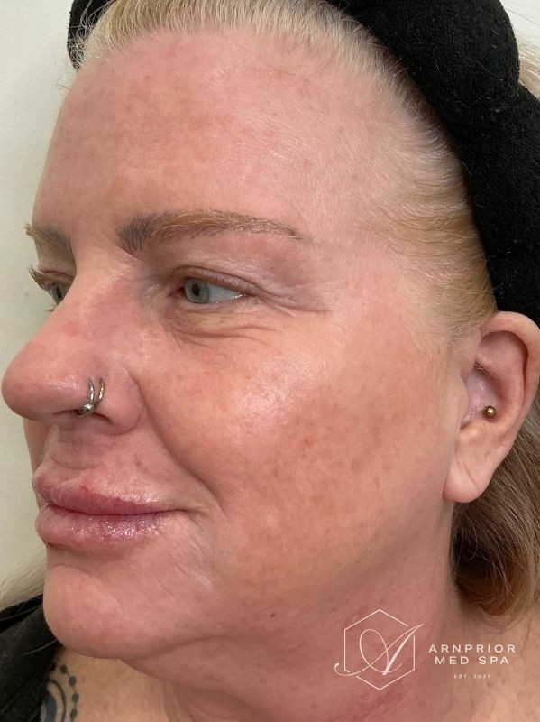 after CO2 Skin Resurfacing