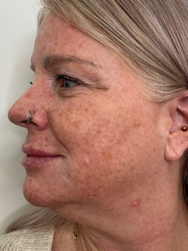 before CO2 Skin Resurfacing