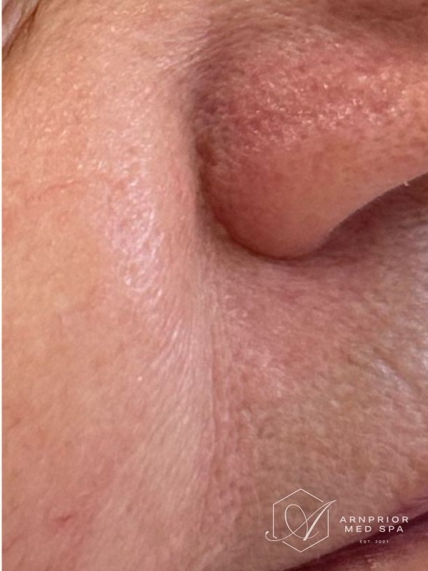 Visible nasal capillaries after vascular laser treatment