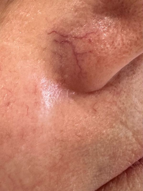 Visible nasal capillaries before vascular laser treatment