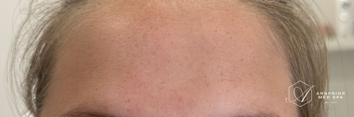 Forehead wrinkles after Dysport in Arnprior ON