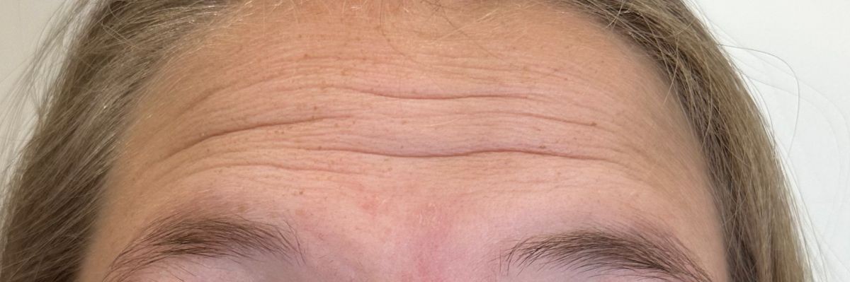 Forehead wrinkles before Dysport in Arnprior ON
