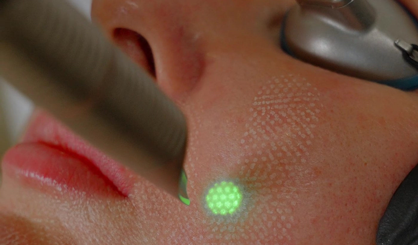 The Fotona 4D fractional handpiece, its green aiming beam and the treated pattern across a client cheek, at Arnprior Med Spa