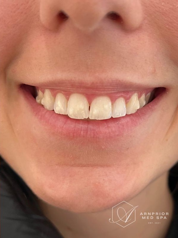 Gummy smile after neurotoxin treatment at Arnprior Med Spa