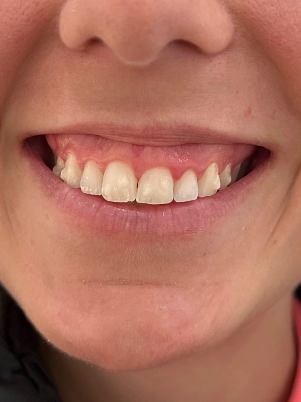 Gummy smile before neurotoxin treatment at Arnprior Med Spa
