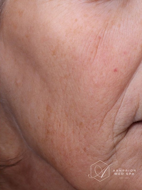 Hyperpigmentation after Laser Toning in Arnprior Ontario