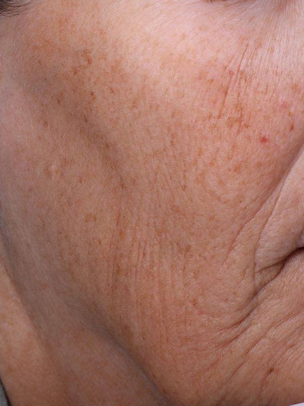 Hyperpigmentation before Laser Toning in Arnprior Ontario